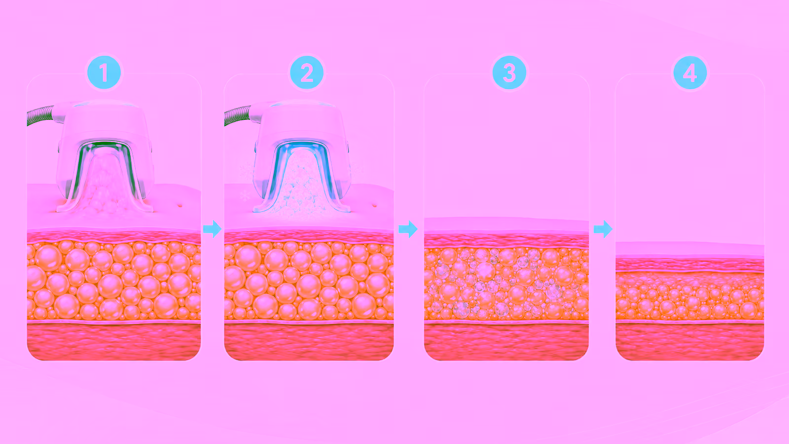 Four-stage illustration showing tissue positioned inside a cooling applicator, fat cells visibly frozen within the cup, gradual breakdown of affected cells and a reduced treated fat layer